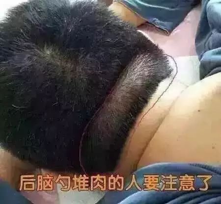 脑后的堆肉脑梗的前兆