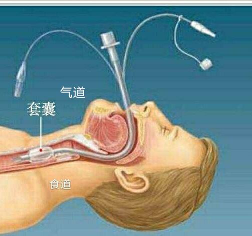 一例气管插管患者胃管置入困难的案例分享