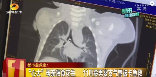                     你还在这么干吗？母亲将咬碎食物放到11个月孩子嘴里！孩子差点没了命！