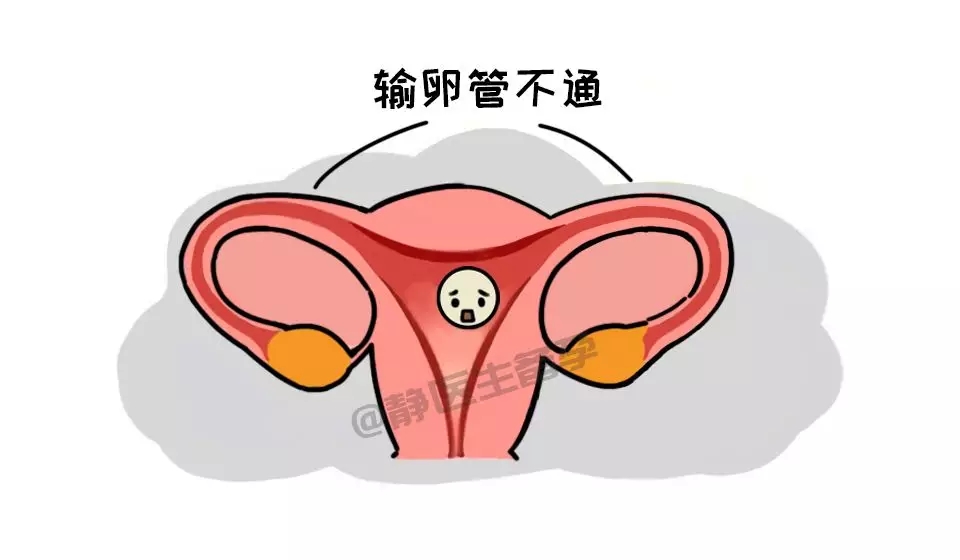 静医生备孕:勿把宫外孕当月经,后果很严重!_输卵管