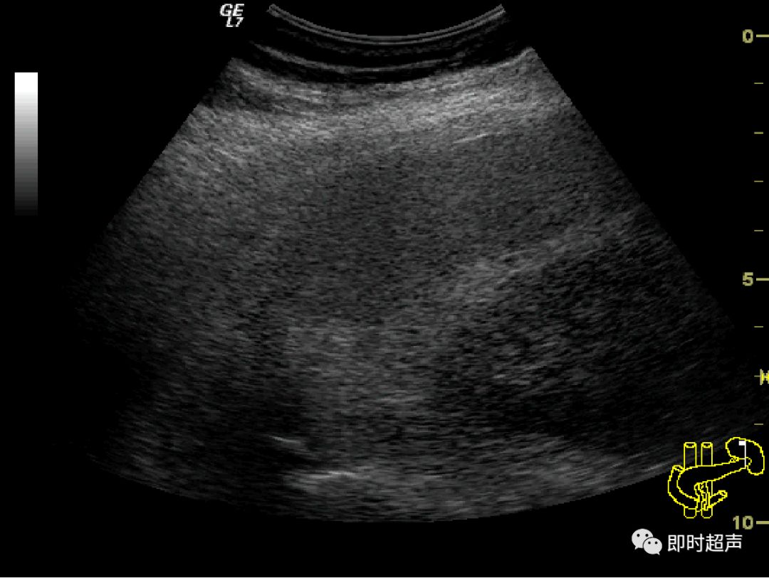内脏损伤的超声诊断