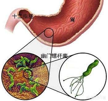 治疗消化系统幽门螺旋杆菌药汇总，对身体状况来选择用药