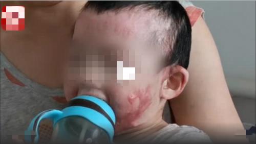                     1岁女童不慎翻入沸水，全身烧伤45%，如今疤痕遍布，面目全非