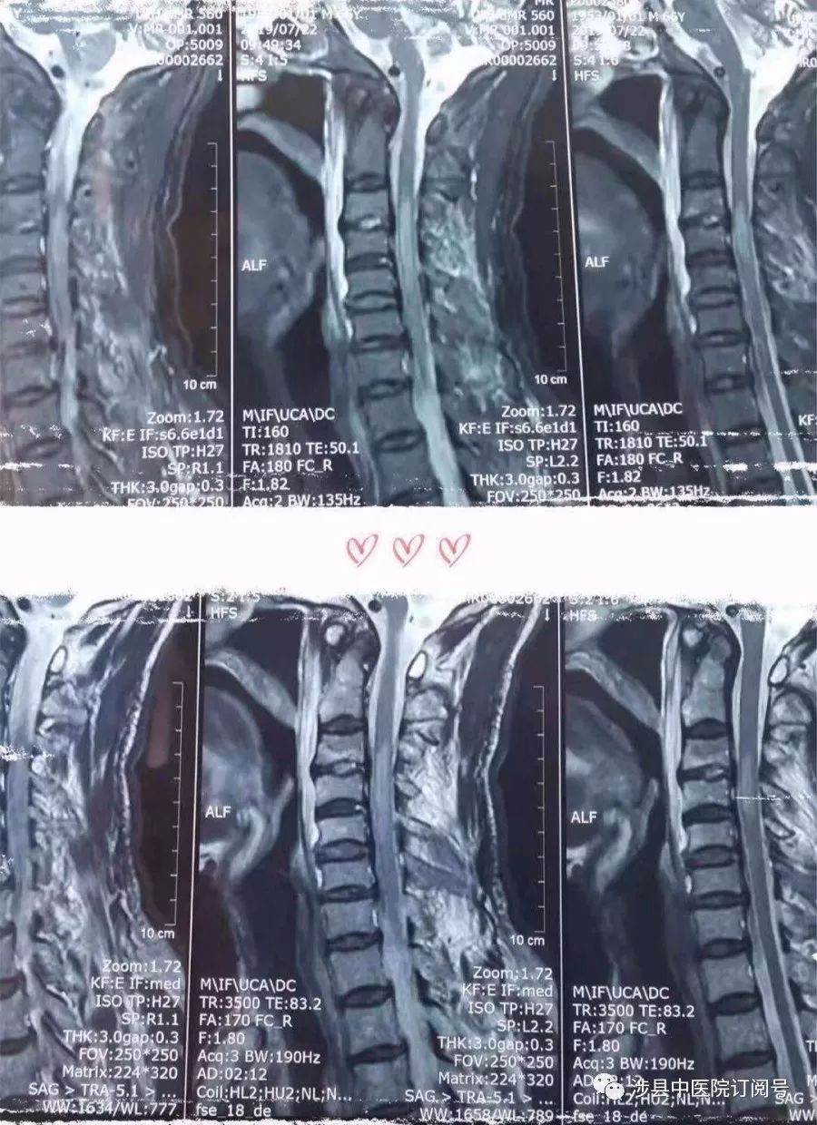 查颈椎核磁示:颈3-6椎体棘突骨折,颈部软组织水肿.