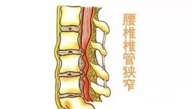 有人说腰椎管狭窄可以自愈是真的吗