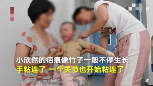                     1岁女童不慎翻入沸水，全身烧伤45%，如今疤痕遍布，面目全非
