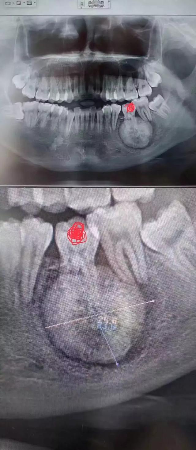 患者是30多岁的年轻男子,红色标记那颗牙松动,要求拔牙,开始嫌麻烦不