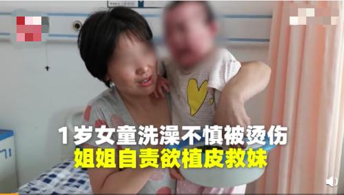                     1岁女童不慎翻入沸水，全身烧伤45%，如今疤痕遍布，面目全非