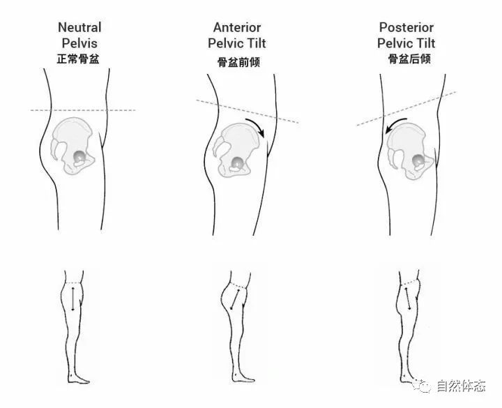 你有骨盆后倾吗?