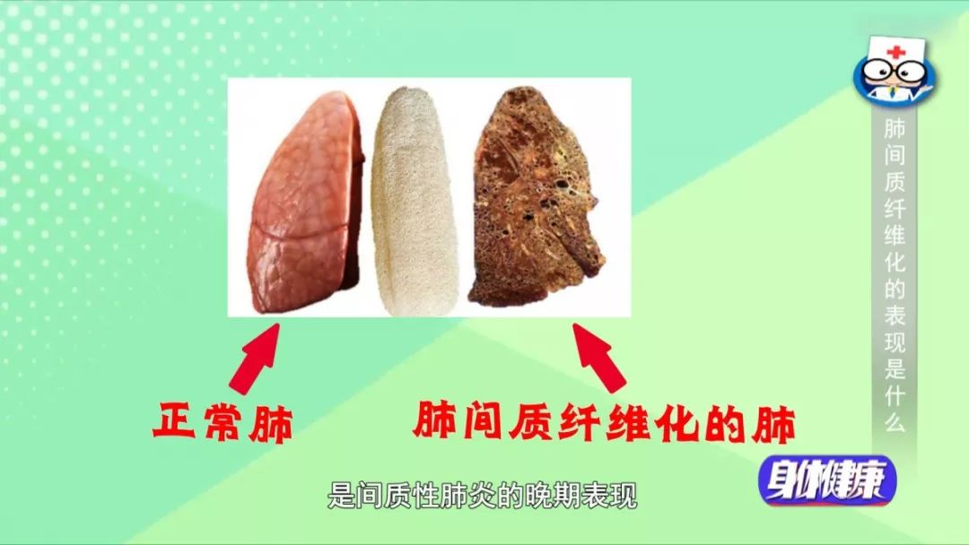 得了肺间质纤维化的肺是什么样?