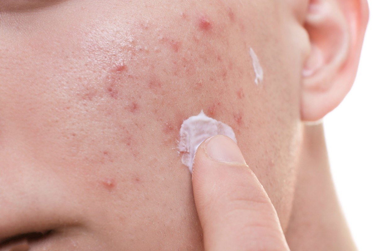 红色痘印、黑色痘印、瘢痕型痘坑,你是属于哪一种痘印?