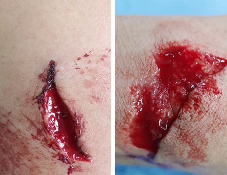 在急诊经常会遇到各种创伤伤口或皮开肉绽,或血肉模糊应用整形外科