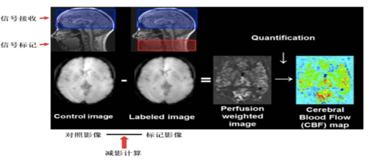 神经影像| 无需注射造影剂的脑灌注成像:磁共振asl技术进展及应用
