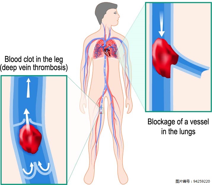 有血栓的人口比例_腿上有血栓真人图片
