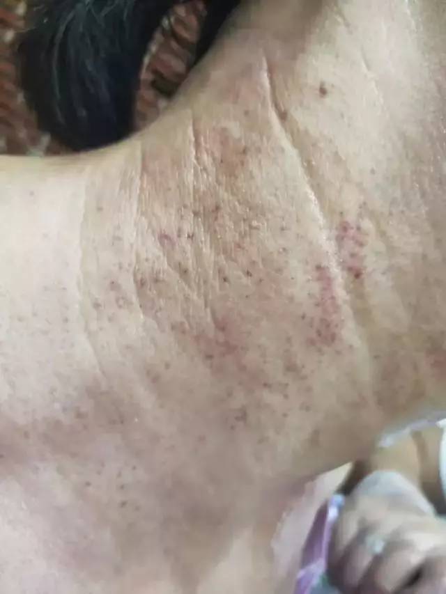 李氏砭法|8次刮痧甲状腺肿瘤4a变三类!