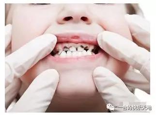                     准妈妈不补钙 宝宝牙齿很糟糕