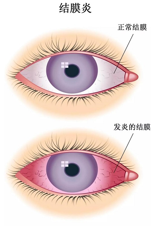 眼睛总是痒痒的秋季要警惕结膜炎的发生