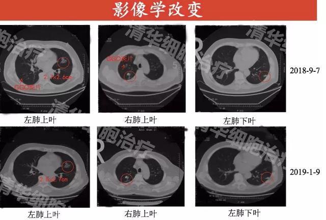 80岁老人查出同时患上四种癌症,经过21个月治