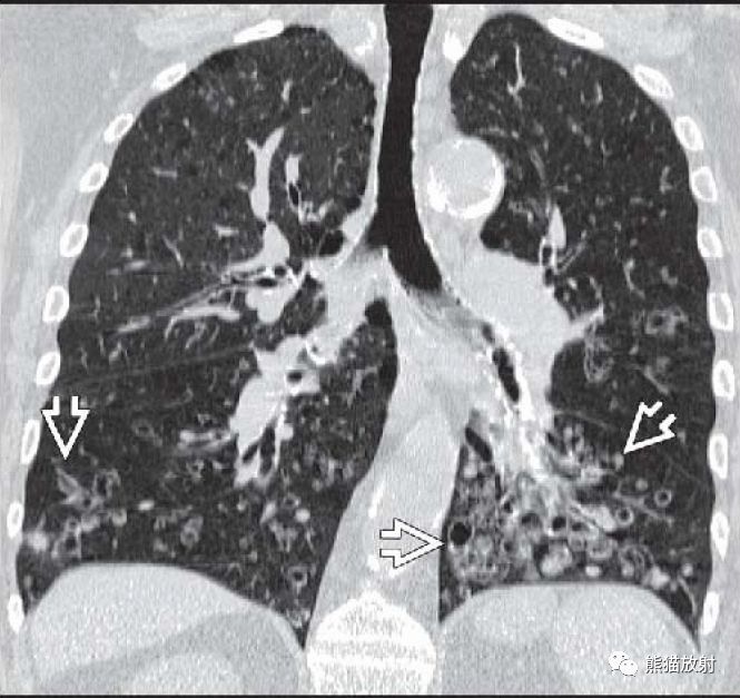 支气管扩张丨ct表现,诊断要点