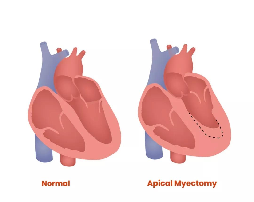 心脏的"墙"越来越厚,离心衰仅一步之遥,只因没控制好它?