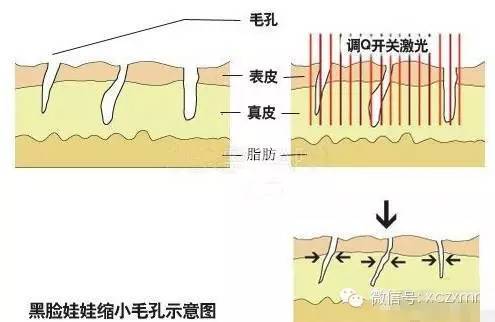 "黑脸娃娃"vs"白瓷娃娃"嫩肤全解析【许昌市人民医院整形美容外科】