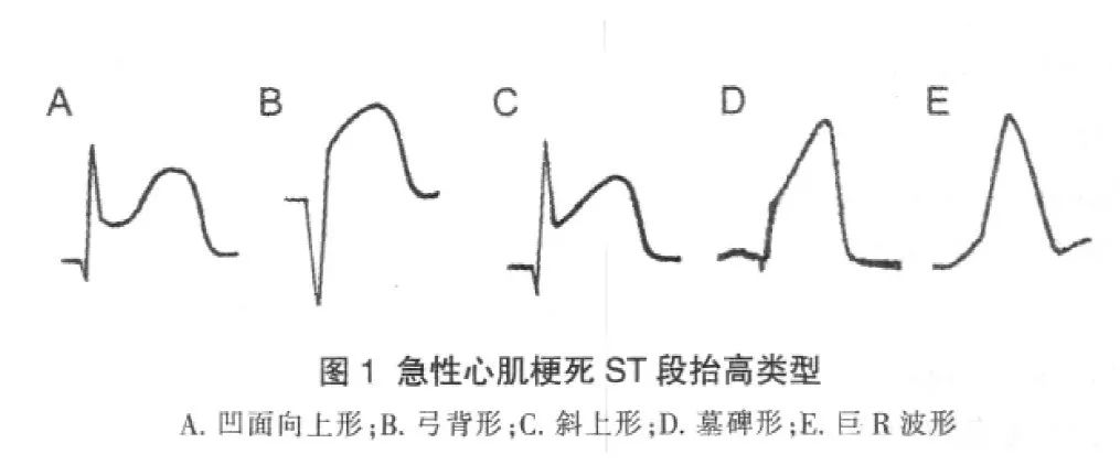 急性心肌梗死ST 段抬高的形态和诊断误区