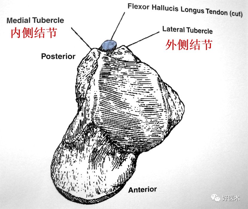 距骨骨折的治疗方法全解析，值得一看！下关 