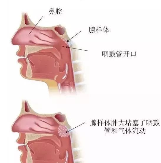 腺样体肥大早期有哪些表现?