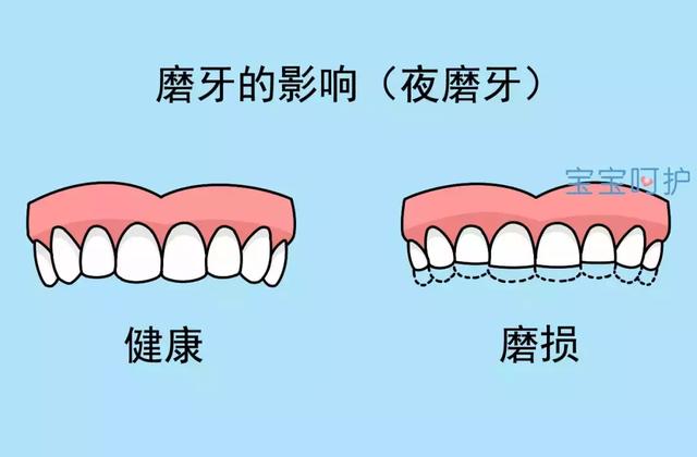 宝宝长期夜磨牙会使得咀嚼肌疲劳,可能引起下颌骨的变形,影响宝宝的