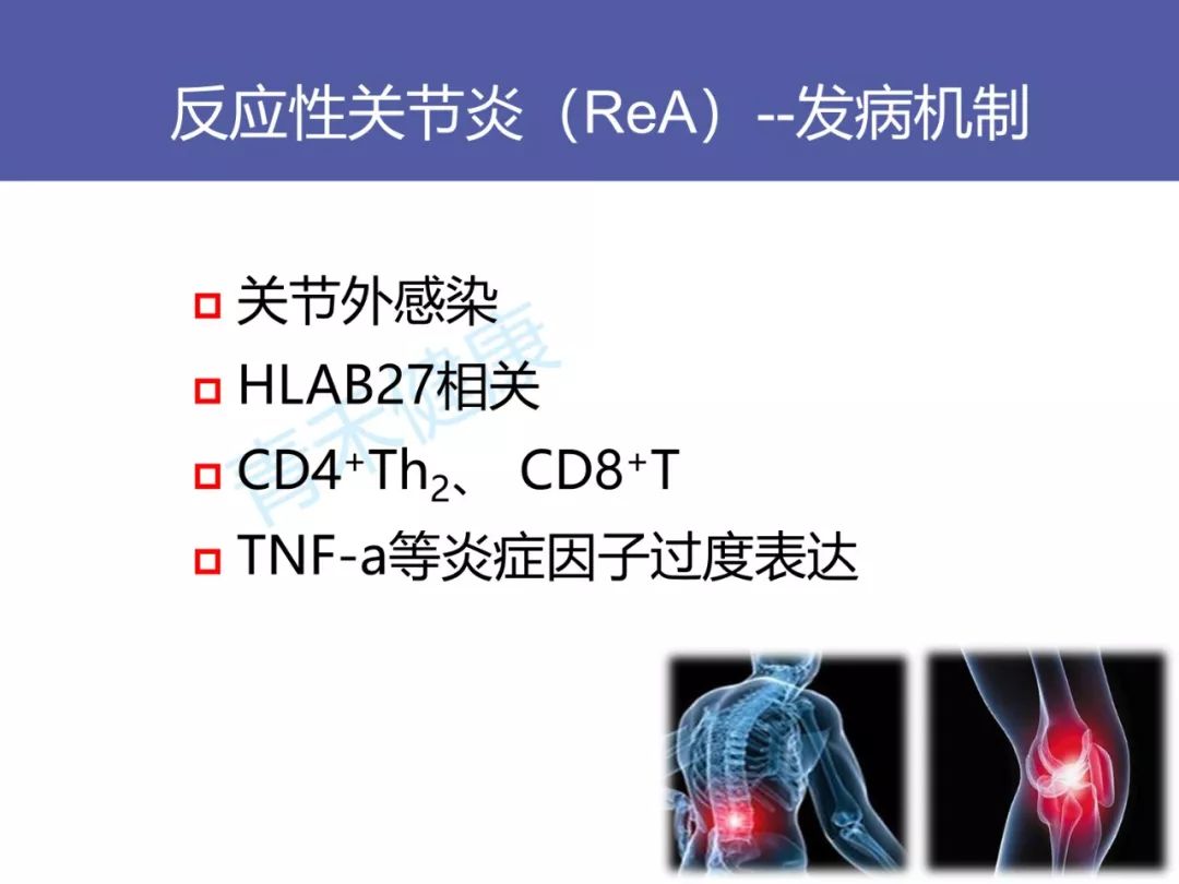 观点交锋反应性关节炎是否需要抗感染治疗