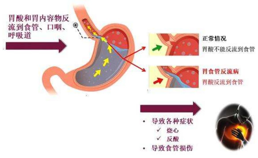 什么是胃食管反流病?