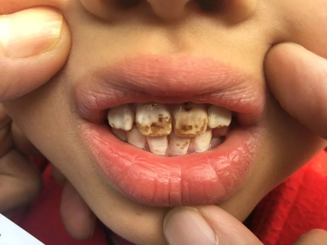 儿童蛀牙的原因是什么？