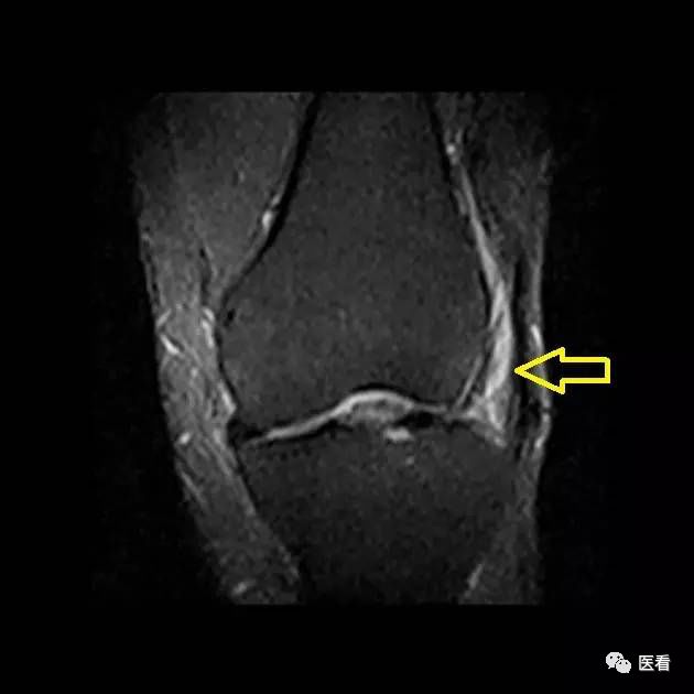影像表现:膝关节 mri 冠状位 t1wi 和 fs-t2wi 序列显示,髂胫束远端