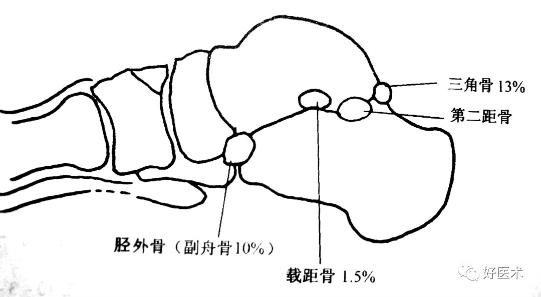 主要是足背伸时胫骨远段前缘挤压距骨头或踝跖屈位时轴向压力造成距