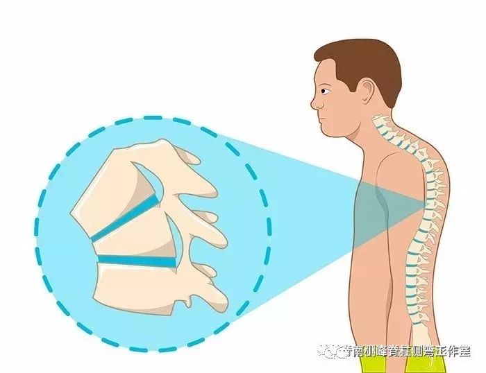脊柱后凸畸形-休门氏症