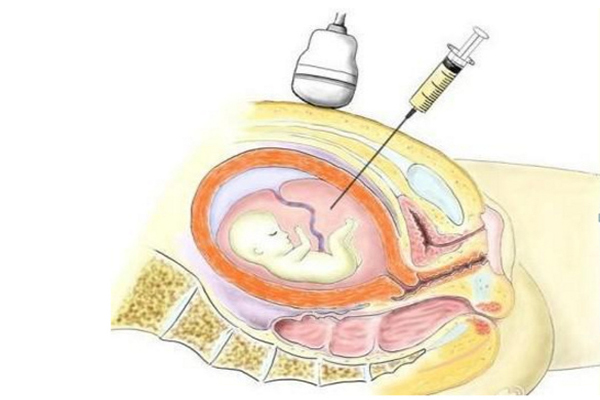 羊水穿刺疼吗 羊水穿刺怎么查