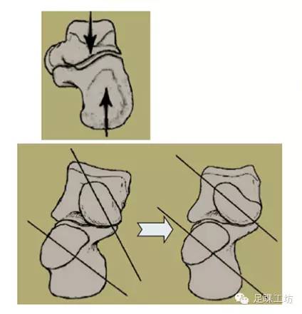 脚跟着地–跟骨外翻–振动吸收–足部机动脚趾着地–股骨内翻–杠杆
