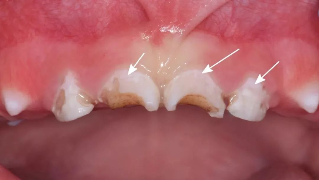 所以说,孩子牙齿脱矿和缺钙无关,而是没做好牙齿的清洁工作,被牙齿