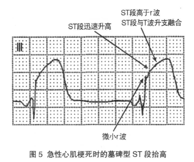 作者认为: 心肌梗死呈墓碑形st 段抬高改变者经冠脉造影证实前降支近