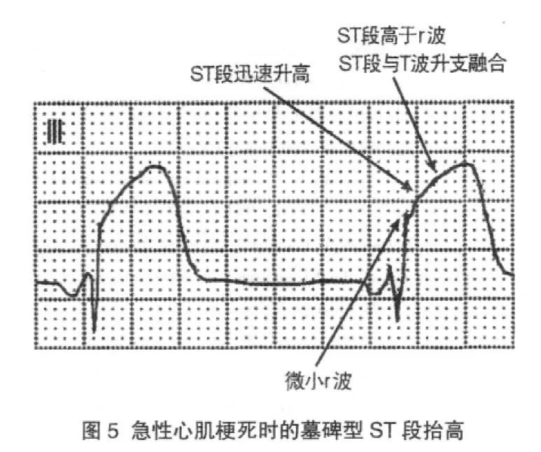 急性心肌梗死ST 段抬高的形态和诊断误区