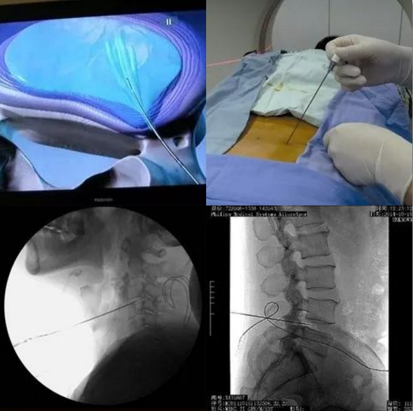 颈椎经皮穿刺椎间盘髓核摘除术