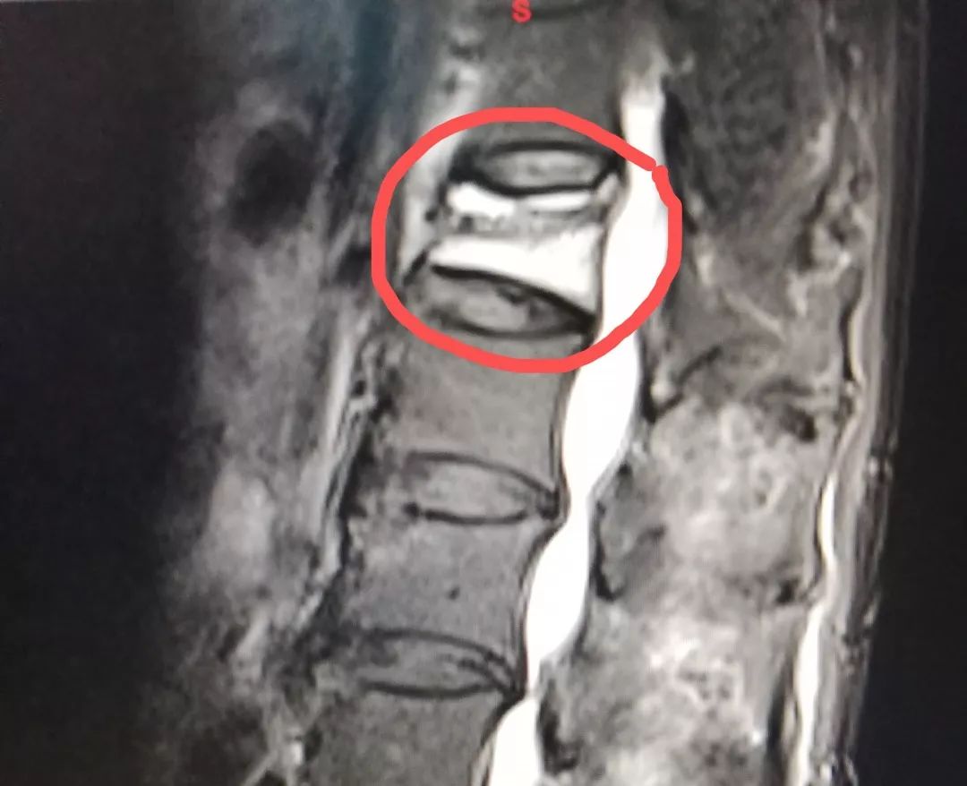 腰椎骨折后,当天就能下床行走?这是啥操作?