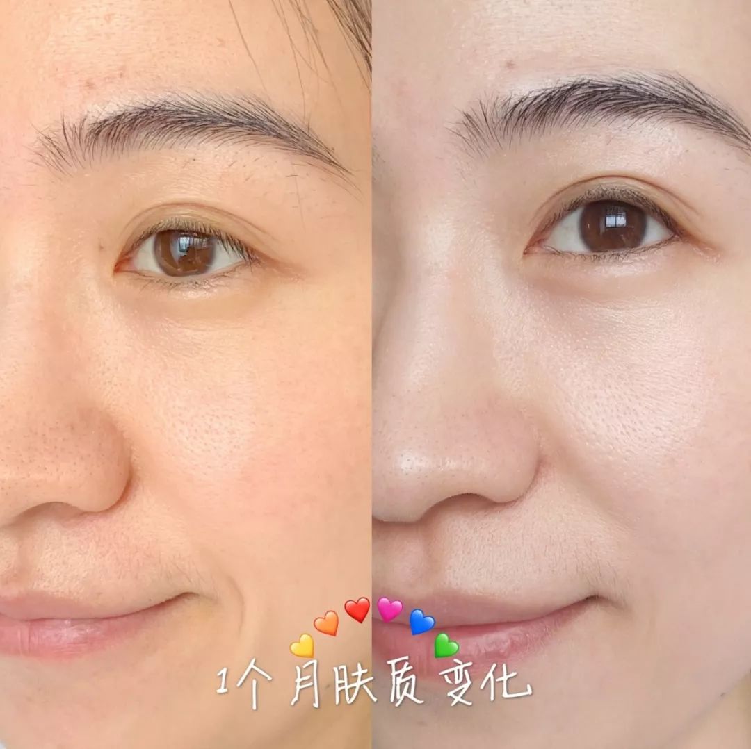 我已经很开心了~皮肤变得水润不再紧紧巴巴的,就算在刷酸进行时,肤况