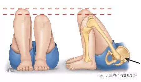 什么是先天性髋关节发育不良儿疾科普