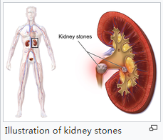 肾结石一般多久会自己掉 305e07ec871b4565bb62acab23a9e95f.png