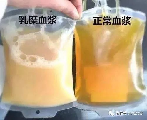 2 输脂肪血有啥后果 脂肪或乳糜状血不但影响检验结果的准确性 而且还