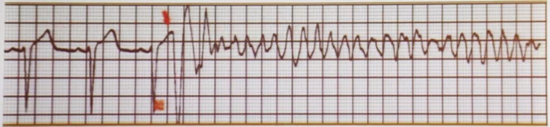 注意了,这些心电图指标预示着恶性心律失常!|心电3分钟