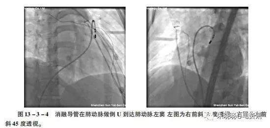 搭脉怎么判断早搏_早搏心电图怎么看图解(3)