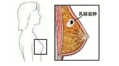 乳腺囊肿