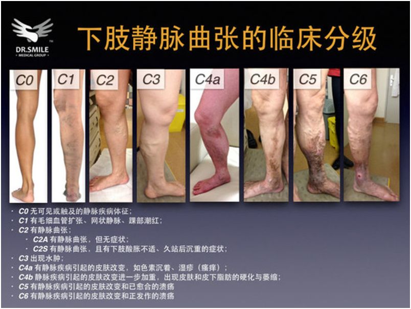 根据下肢静脉曲张的严重程度及症状,国际上采用ceap分级,分为c0—c6级